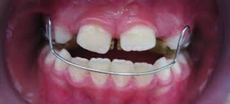 Arc d’Eschler chez l’enfant à Marseille 13012 : à quoi ça sert et quand consulter un orthodontiste à Saint-Barnabé ?