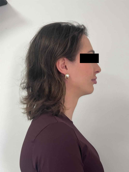 Feminização do rosto na pessoa transgênero graças à cirurgia das mandíbulas em Marselha