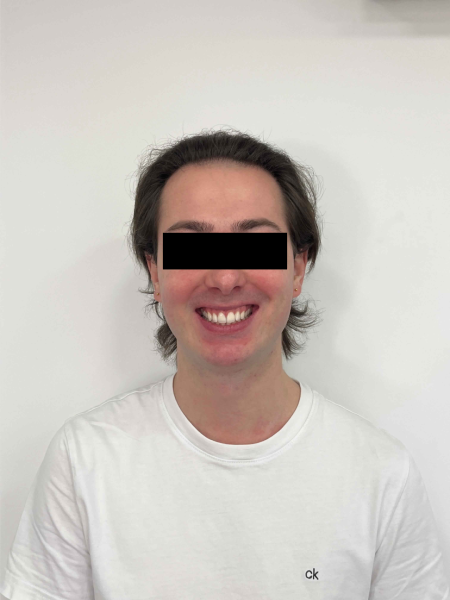 Féminisation du visage chez la personne transgenre MtF grâce à la chirurgie des mâchoires à Marseille