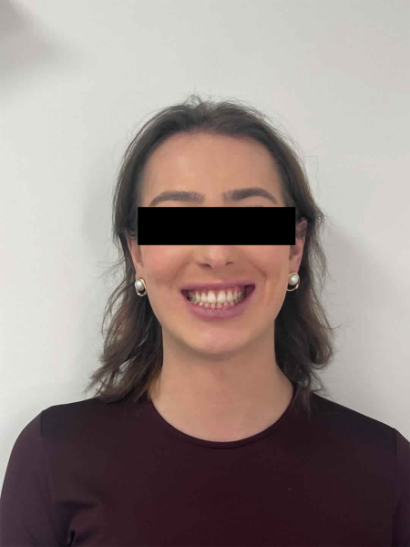 Féminisation du visage chez la personne transgenre MtF grâce à la chirurgie des mâchoires à Marseille