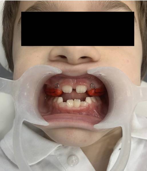 Les étapes du traitement orthodontique pour les enfants : guide clinique pour les parents