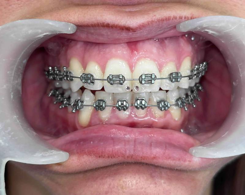 Comment se passe le collage des bagues orthodontiques à Marseille Saint-Barnabé 13012