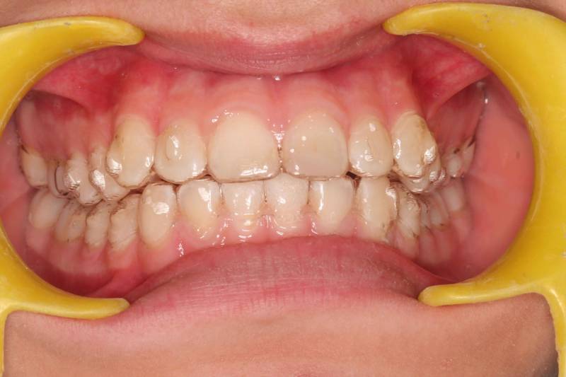 Pose de gouttières Invisalign pour avoir un beau sourire chez votre orthodontiste à Marseille