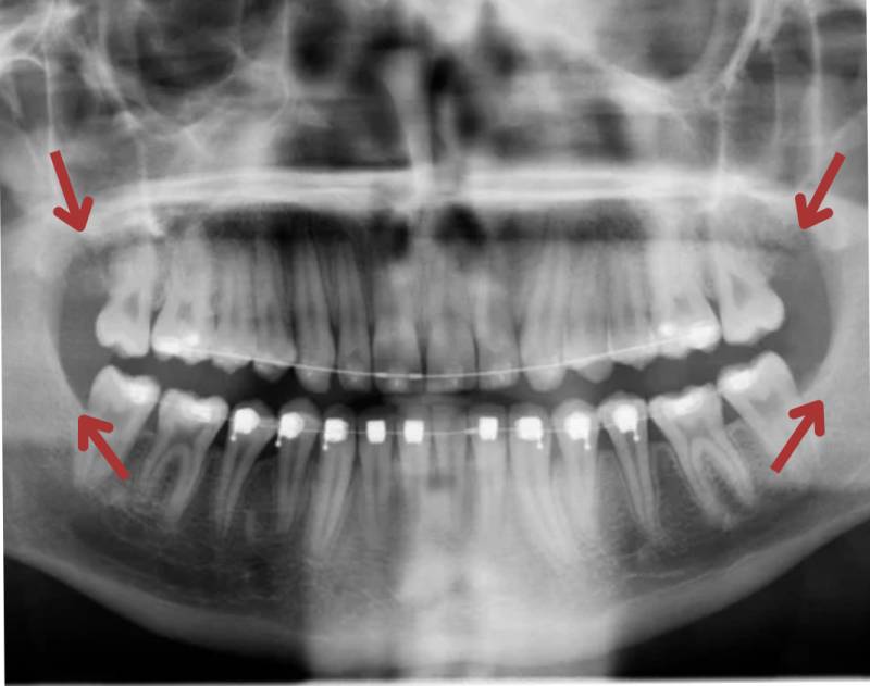 Intervention chirurgicale pour se faire enlever les dents de sagesse avec le cabinet d'orthodontie du docteur Madar à Marseille 12ème