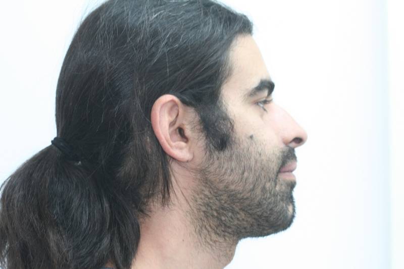 Comment corriger un prognathisme chez l’adulte avec orthodontie et chirurgie maxillo-faciale à Marseille